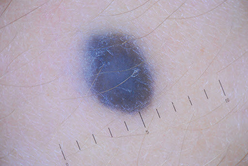 Голубой невус мимикрирует под меланому, но при этом практически неопасен