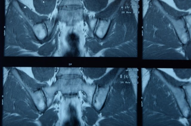    Что такое болезнь Бехтерева и как она возникает?