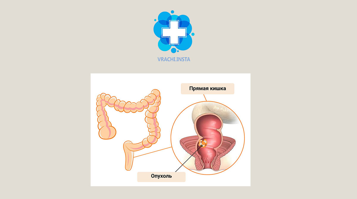 Рак прямой кишки. Клинический случай. | Vrachi.insta | Дзен