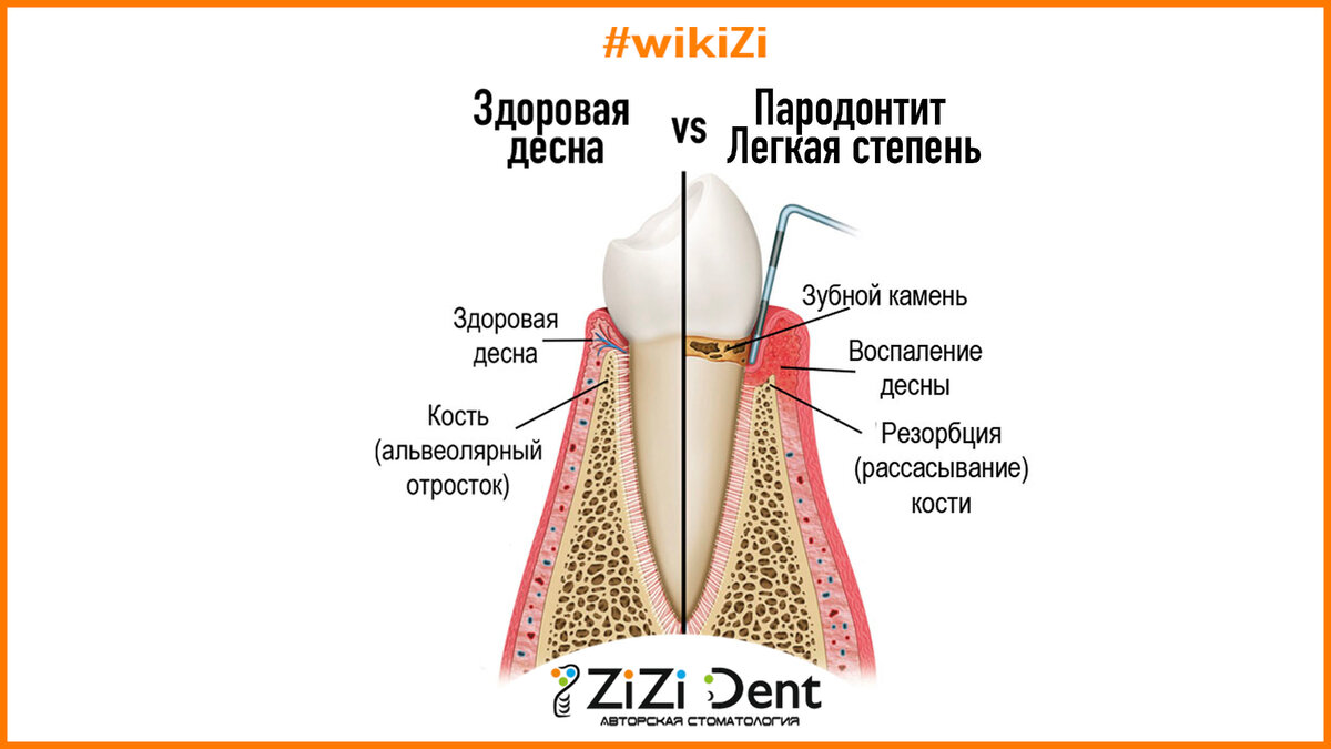 Начальная стадия пародонтита