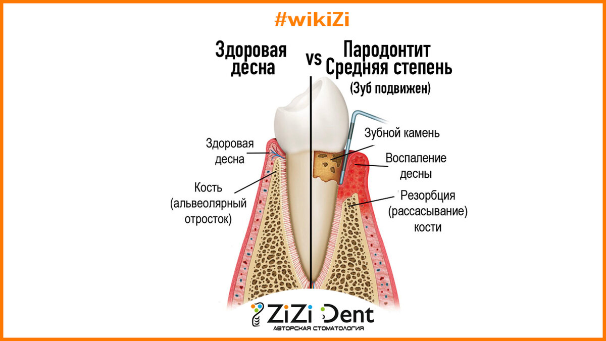Средняя степень пародонтита