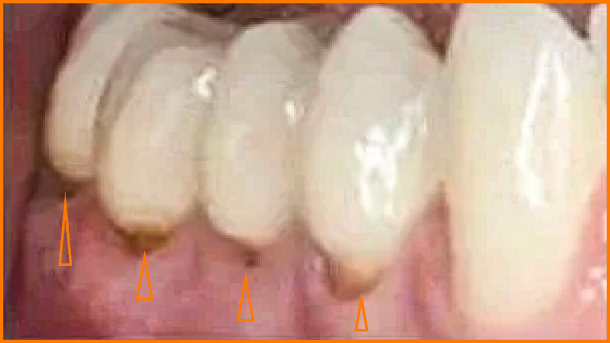 Клиновидные дефекты