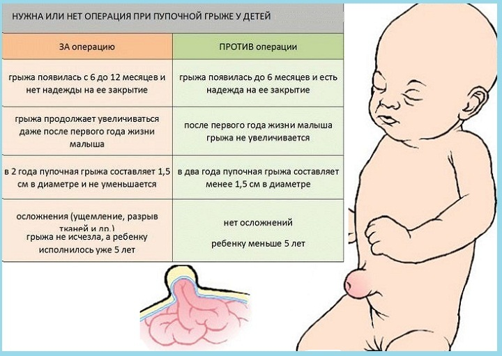 Пупочная грыжа у новорожденных