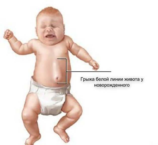 Как выглядит пупочная грыжа у детей