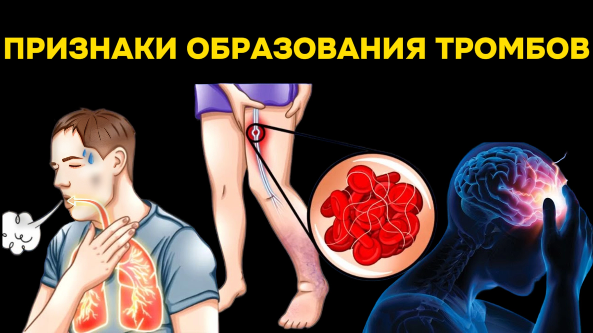 В этой статье мы поговорим о девяти предупреждающих знаках и признаках, которые могут указывать на то, что в нашем организме могут образоваться опасные тромбы.