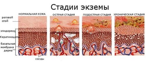 ЭКЗЕМА И ЕЕ ВИДЫ.