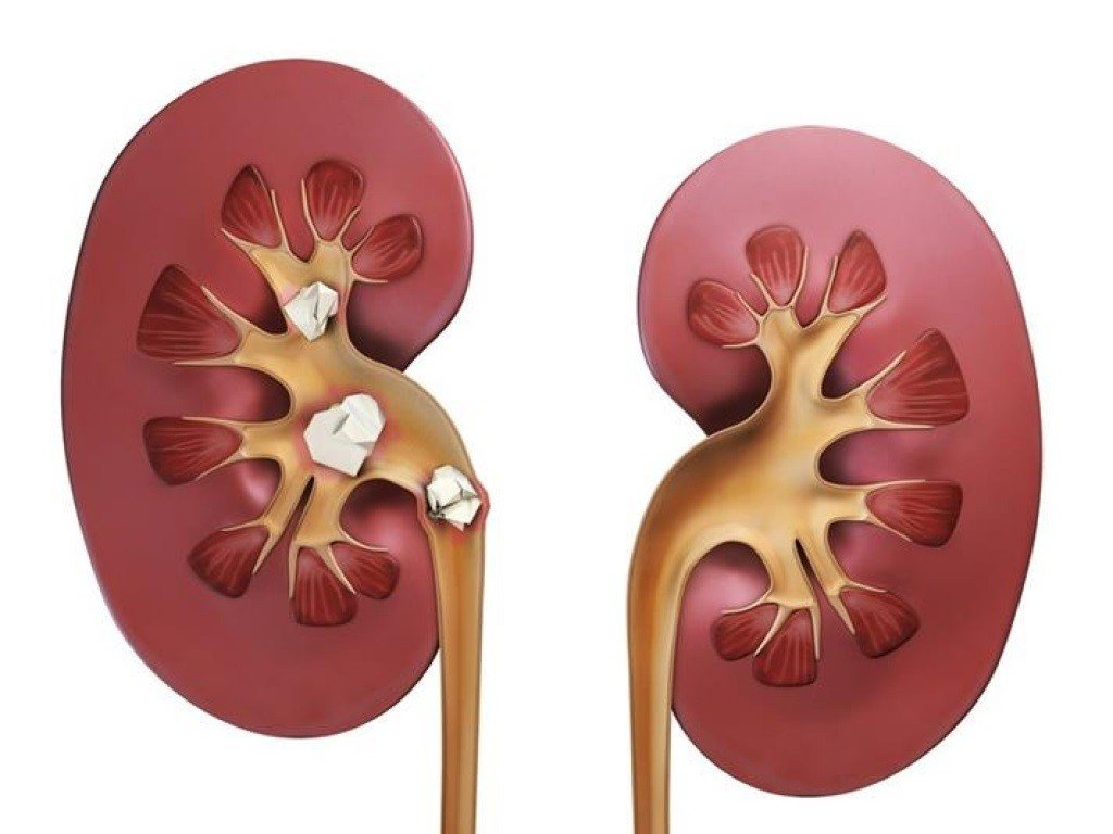 Аномалии развития почек. Причины почечной недостаточности у женщин. Правосторонний нефроптоз почки 1 степени. Факторы риска почечной недостаточности. Может ли быть 3 почки.