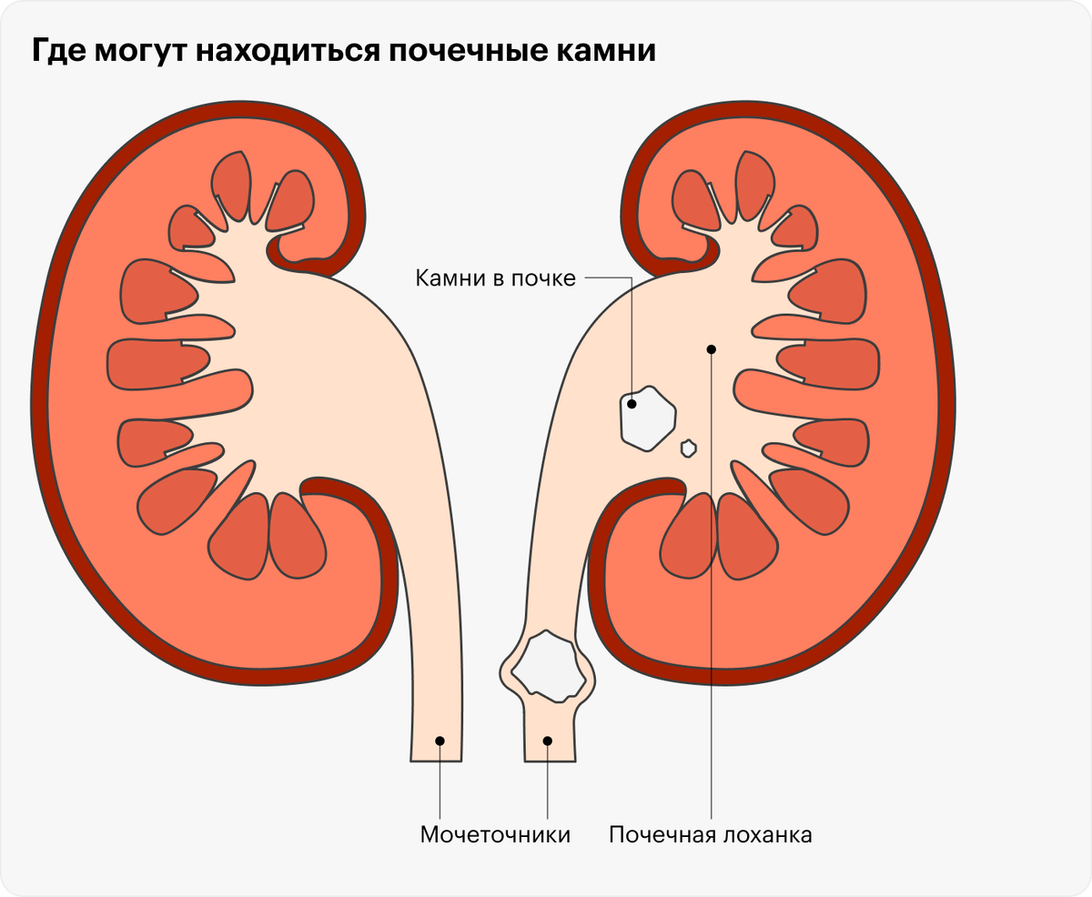 Болит бок камень в почке