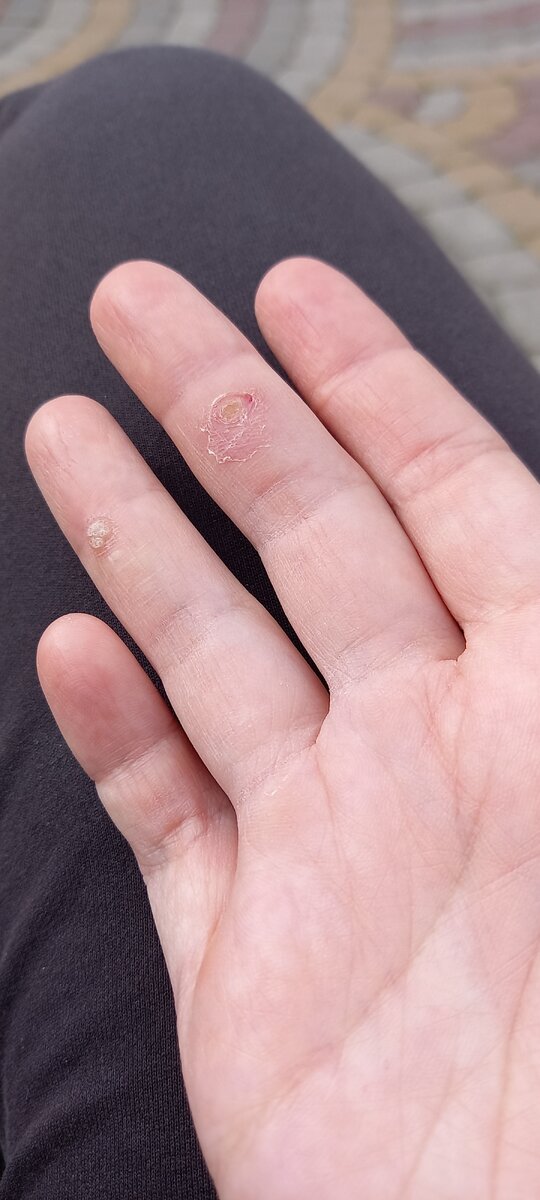 бородавка на безымянном пальце до очистительной программы