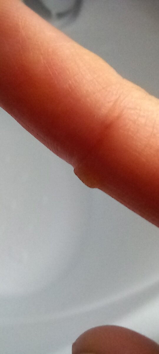 Бородавка до старта детокс марафона