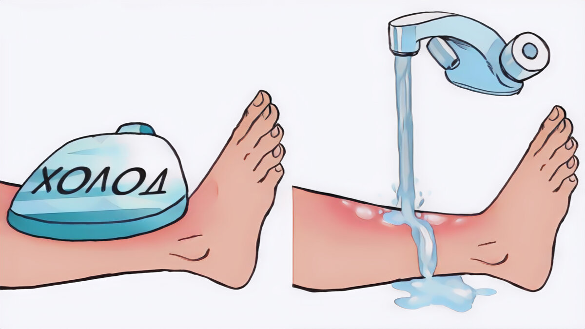 При небольшом ожоге обожжённый участок можно поместить под струю холодной воды из крана на 10–15 минут, при обширных ожогах этого делать нельзя