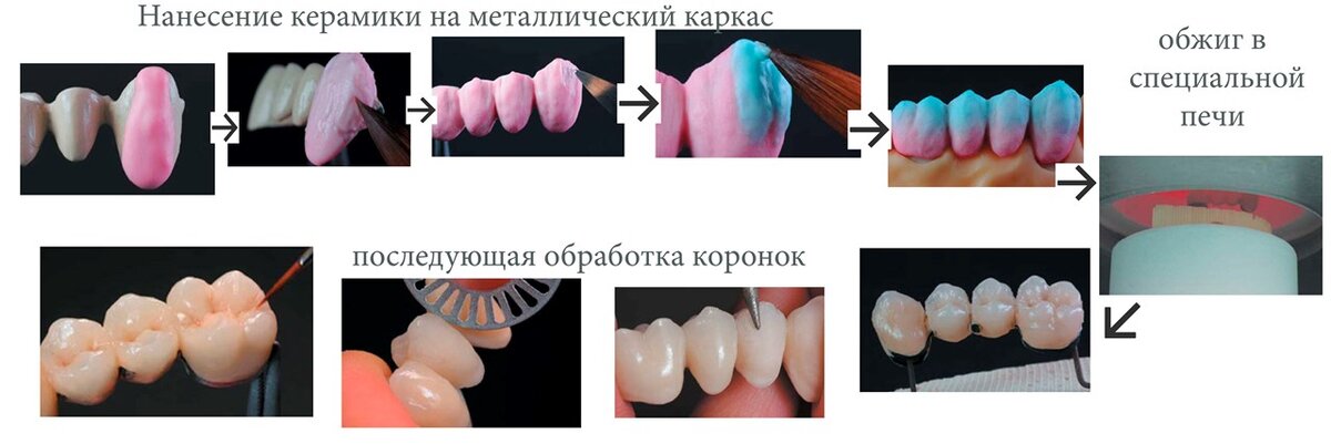 Отбеливание зубов Примеры и фото отбеливания Ростов-на-Дону