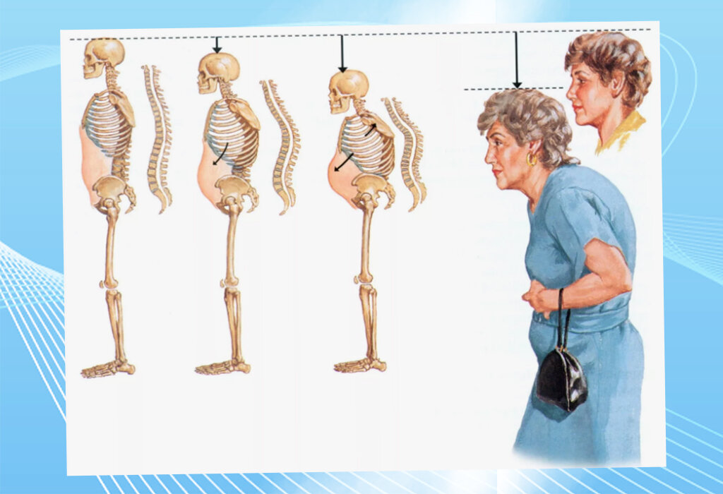 Коллаж автора. Что происходит телом при возрастной мышечной атрофии