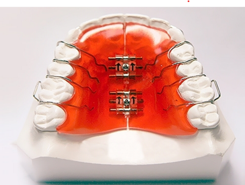 ортодонтические аппараты