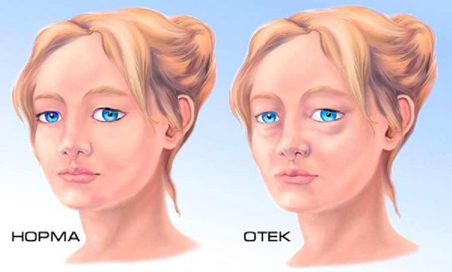 Многие пациенты сталкиваются с развитием отеков на лице, и во многих случаях это не только косметическая проблема.