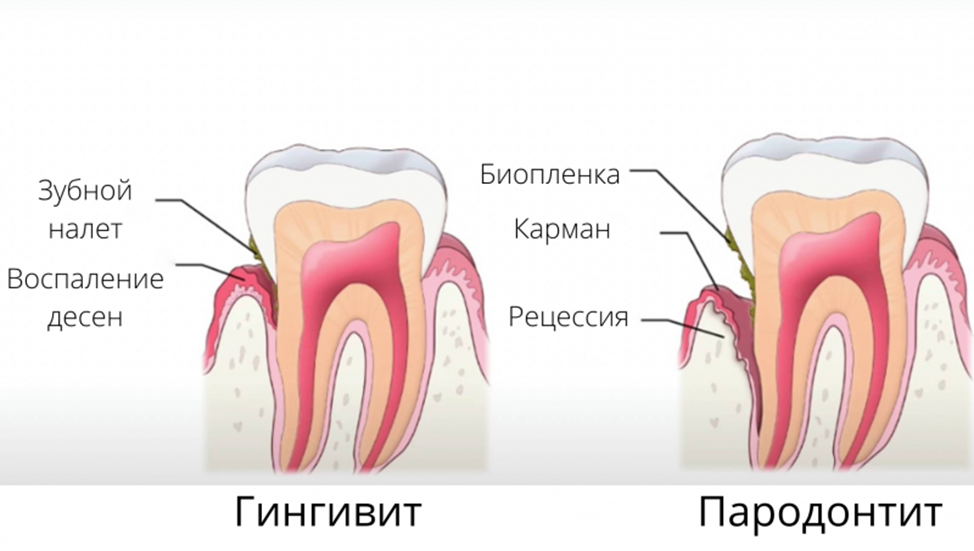 Как снять отек десны в домашних условиях Киста на десне у взрослого Арт Минск.ру