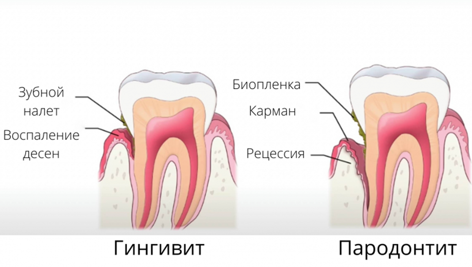 Зубной камень, или с чего начинаются заболевания десен