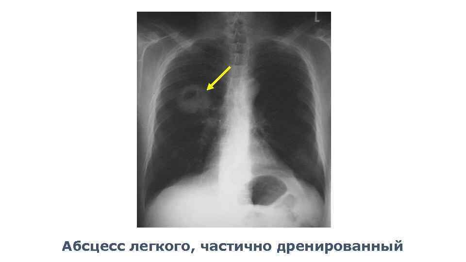 Жёлтая стрелка указывает на абсцесс лёгкого - "шарик" с жидкостью, которая расположена в нижней части образования. Сверху расположен воздух