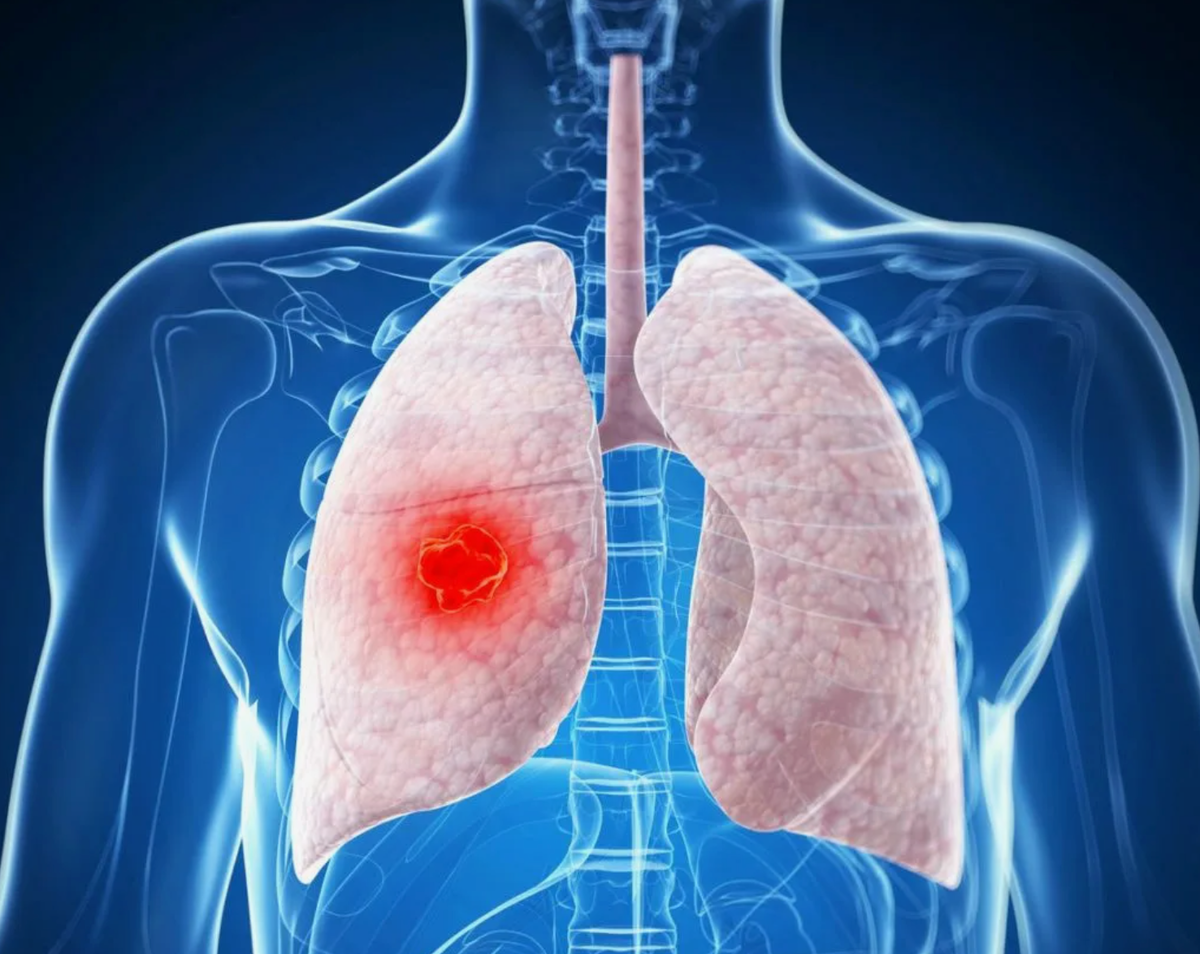  Боль в пояснице – частое явление и редко является признаком рака. Однако боль в пояснице может быть связана с различными видами онкологических заболеваний.-3