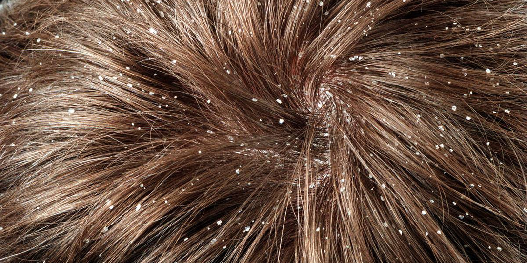 Как избавиться от перхоти?