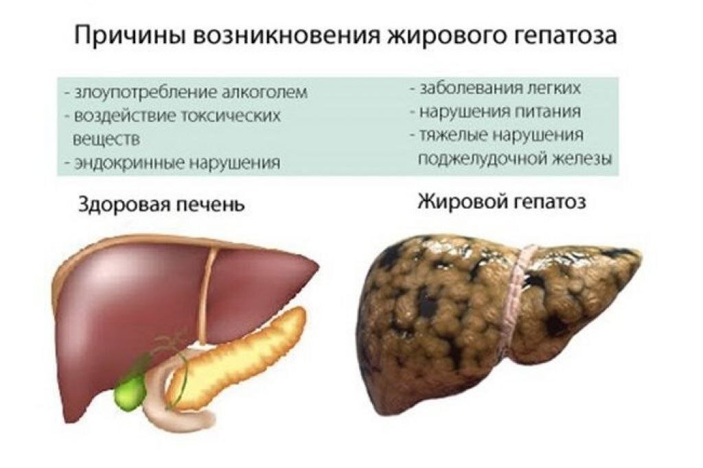 Какие лекарства при жировом гепатозе. Жировой гепатоз развивается при. Гепатоз (стеатоз печени).. Причины развития стеатоза печени. Жировая дистрофия печени (стеатоз.