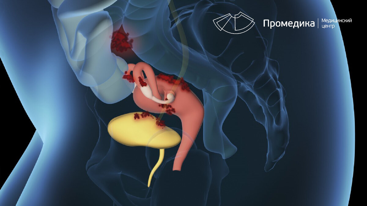 Подозрение на «эндометриоз» – что теперь делать, и как понять, что точно он?