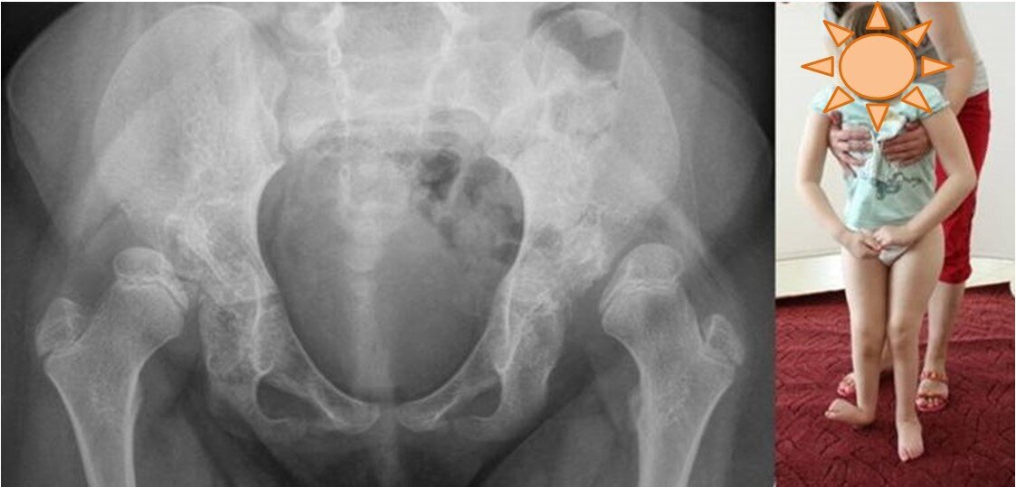 spina bifida ДО операции 