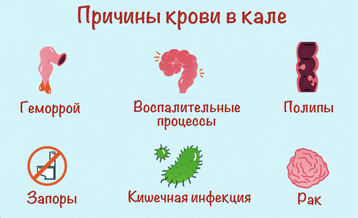 Рак кишечника: как определить его на начальной стадии 17.06.2022, ИноСМИ