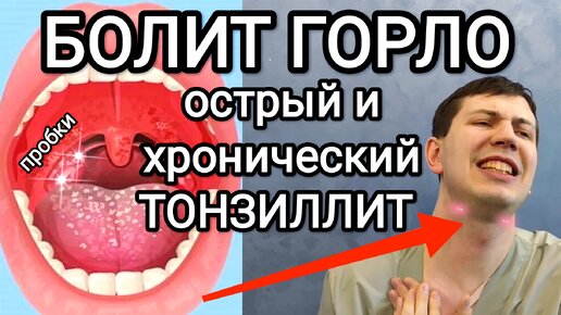 Хронический тонзиллит - симптомы и лечение