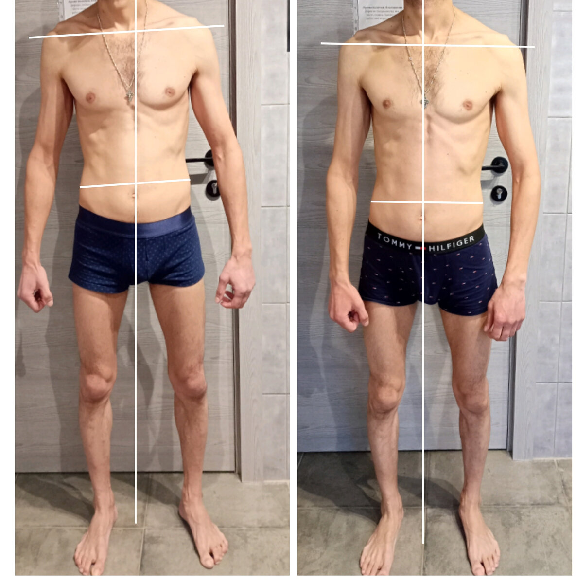 А это тонкокожий. У них более  чувствительная нервная система, более чуткая к стрессу и переживаниям. Сразу заметны существенные скелетные и мышечные деформации, в отличие от «толстокожего»