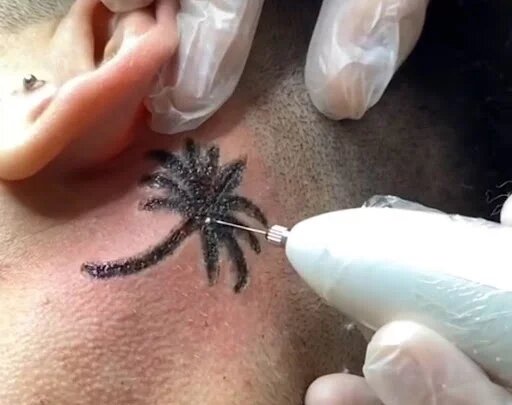 Реально ли удалить тату или татуаж«плазма пеном»?