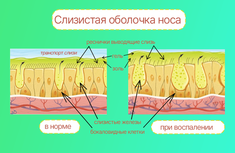 Как убрать заложенность носа в домашних условиях