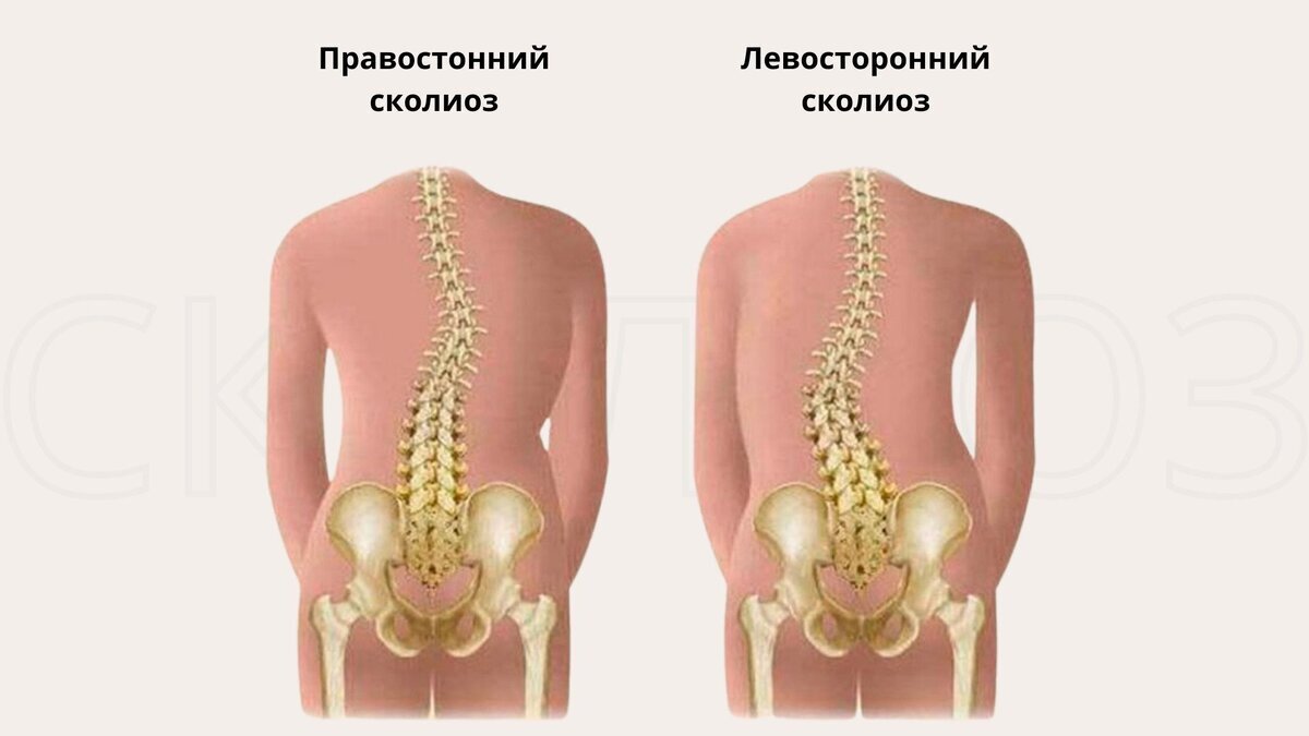 Астма, плоскостопие, сколиоз — не просто диагнозы, чтобы 