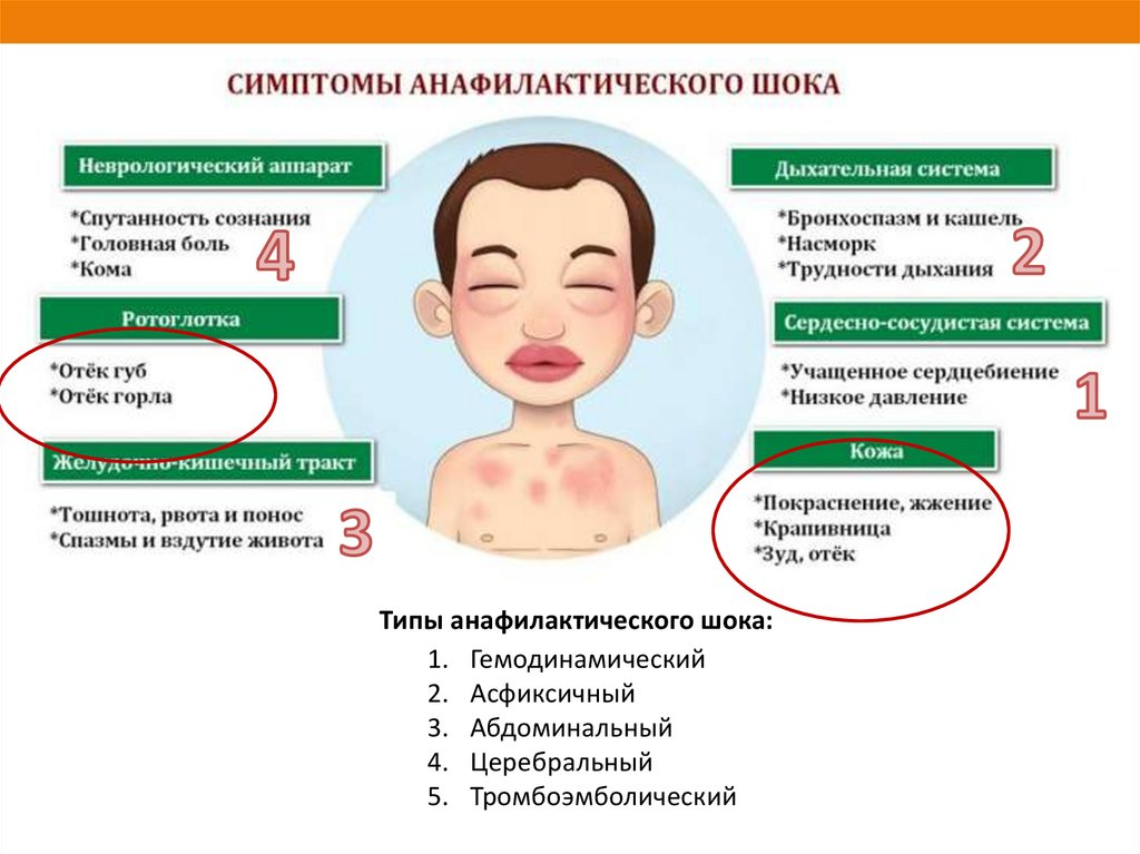 У ребенка 6 день температура и кашель. Анафилактический ШОК симптомы. Крапивница при анафилактическом шоке. Симптомы анафилактический ШОК симптомы. Основные симптомы анафилактического шока.