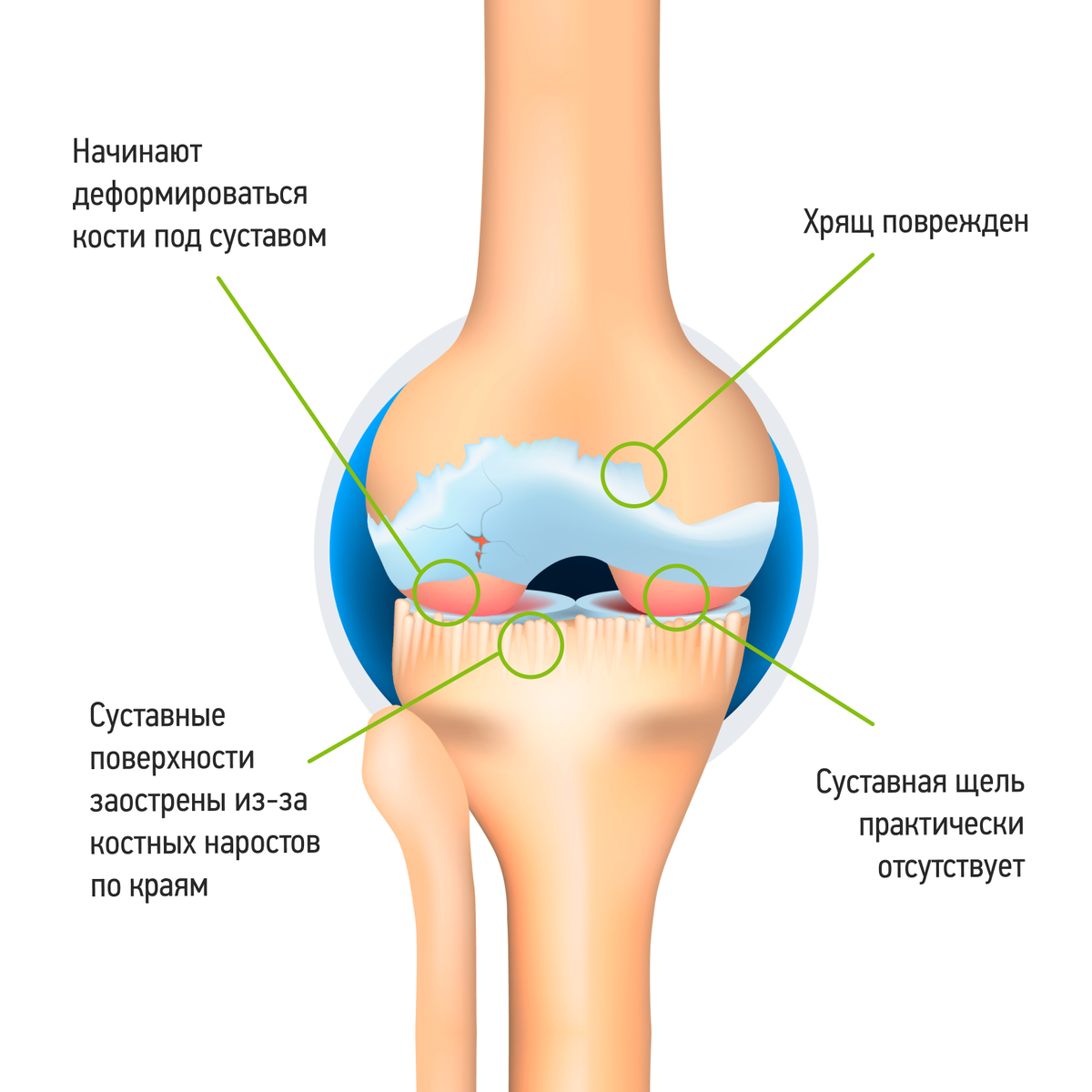 Синовиальная жидкость биопорт