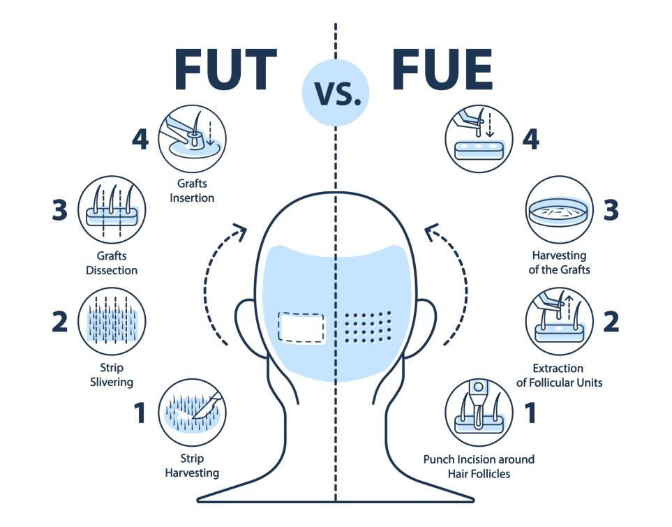 Основные методы пересадки волос (FUT и FUE)