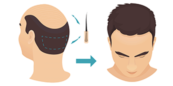 Пересадка волос