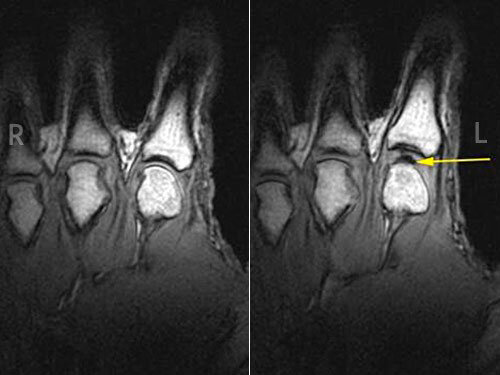 В первую очередь следует разобраться, почему хрустят пальцы. Дело в том, что все суставы наполнены синовиальной жидкостью – природной смазкой, довольно густой. Благодаря ей суставы меньше истираются и дольше служат человеку, не доставляя проблем. Если вытянуть палец, то объем сустава увеличится, а значит, давление в жидкости снизится. Газ, присутствующий повсюду, растворится и превратится в пузырьки. Через мгновение они лопнут с характерным хрустом. Этот звук многие люди принимают за хруст самих суставов.