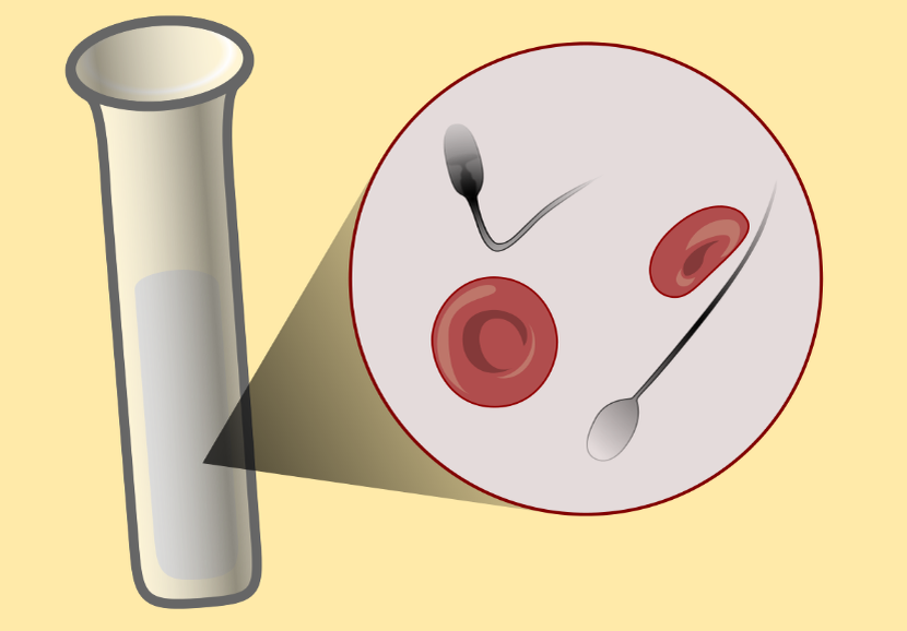 Почему в сперме кровь и что с этим делать