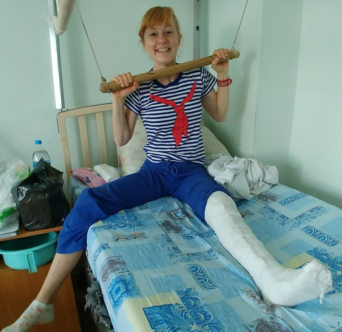 В гипсе. До операции. Импрессионный перелом мыщелка большеберцовой кости