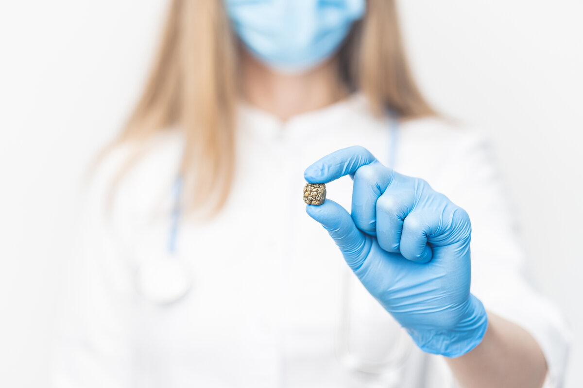 Недрагоценные камни: лечение желчнокаменной болезни | Москва — столица ...