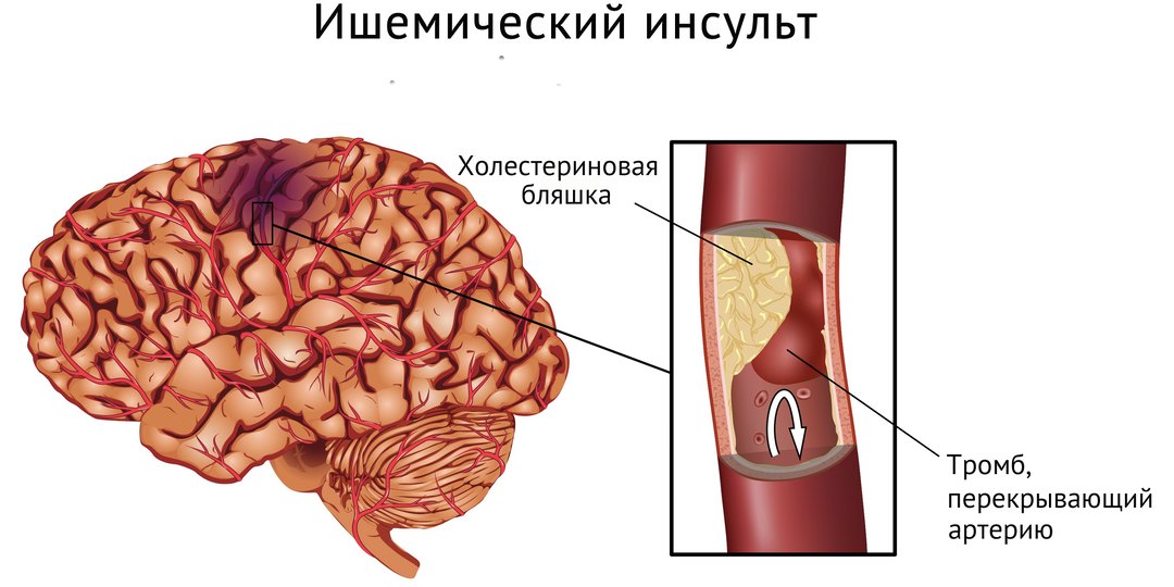 Цикл статей из серии «Инсульт от А до Я»: часть третья – особенности ишемического инсульта