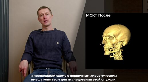 Отзыв пациента о микрохирурчигеской операции. После удаления амелобластомы проснулся сразу с зубами.