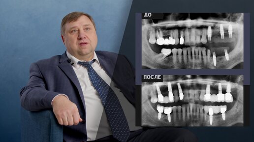 Честный отзыв пациента после синус-лифтинга и установки 9 имплантов за один приём в NKclinic