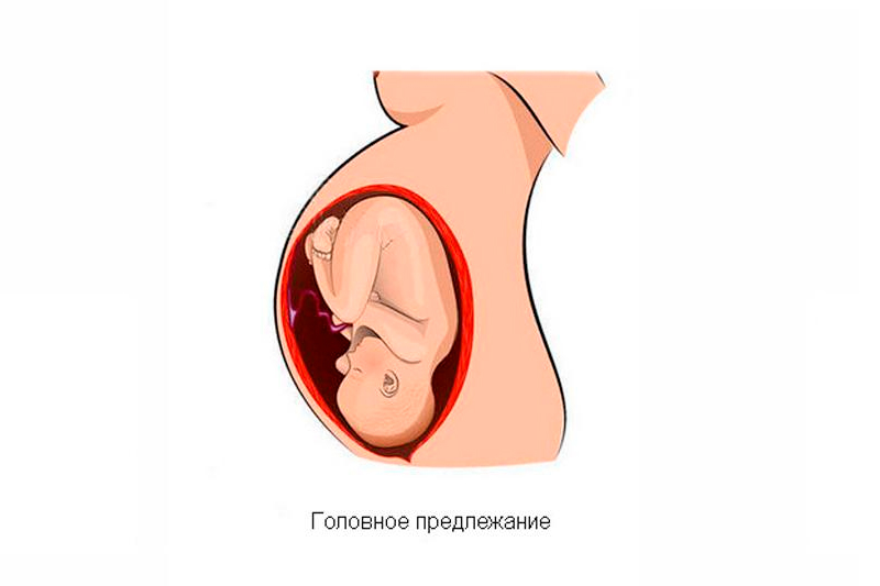 Головное предлежание плода. Правильное положение плода