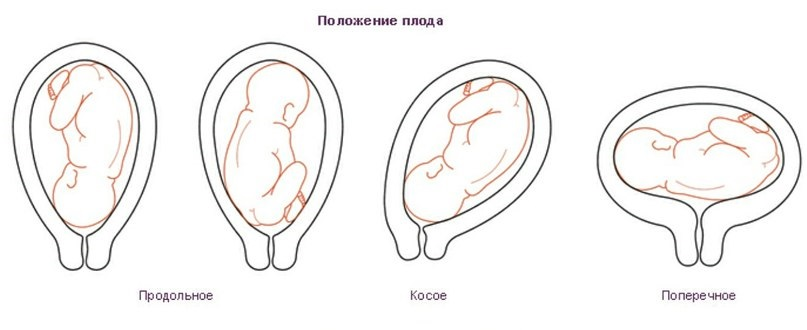 Головное предлежание плода: 1,2 позиция, продольное и низкое