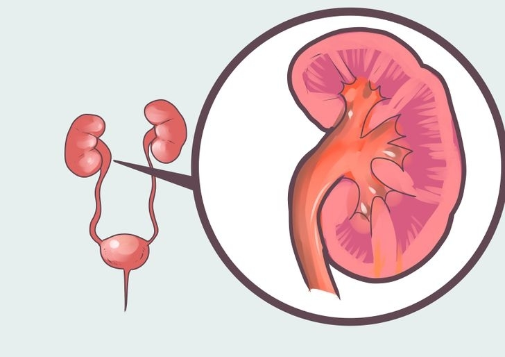 Сегодня день почки: что такое нефротический синдром и могут ли при нем отказать почки?
