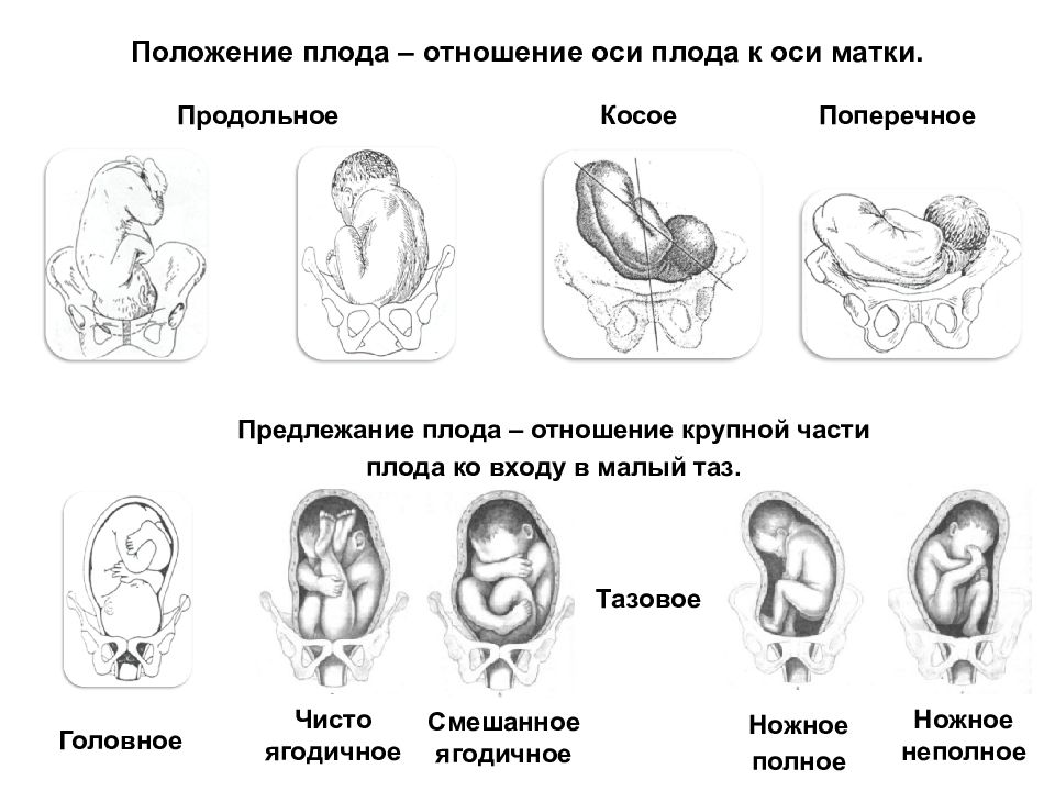 Правильное расположение ребенка в животе перед родами