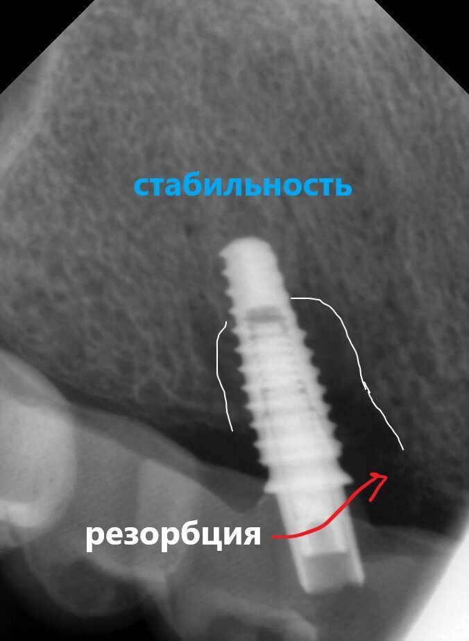 U-образный дефект. Светлый рисунок - кость плотная, чем темнее, тем больше воздуха (это плохой знак). Этот имплантат не выдержал нагрузку - вообще треснул
