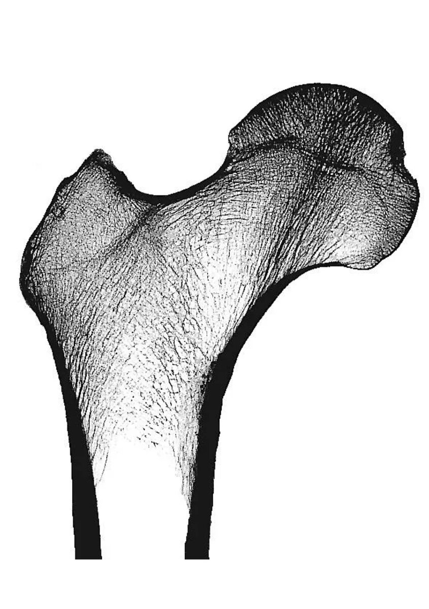 Рентгенограмма верхнего конца бедренной кости